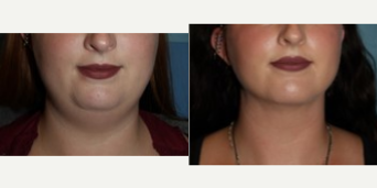 Case: 8995 - before and after photo of 28 Year Old Sun Mental Liposuction Patient by Christopher T. Maloney Jr., MD