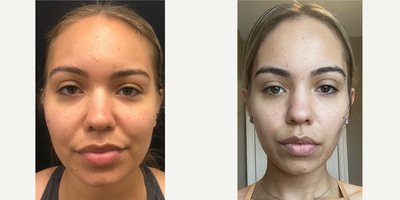 Case: 8996 - before and after photo of 25-34 year old woman treated with Chin Liposuction, Buccal Fat Removal by Mansher Singh, MD, FACS
