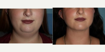 Case 8998 - 25-34 year old woman treated with Chin Liposuction, Liposuction, Liposculpture