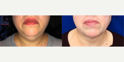 Case 8999 - Woman treated with Chin Liposuction
