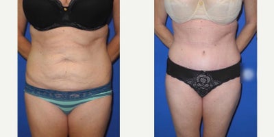 Case: 9 - before and after photo of Woman treated with Tummy Tuck by Shahram Salemy, MD, FACS