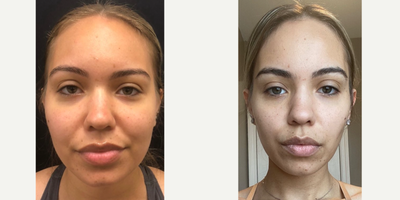 Case 9000 - 35-44 year old woman treated with Chin Liposuction