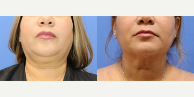 Case 9001 - Chin Liposuction