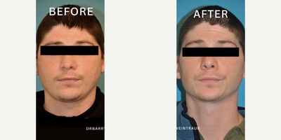 Case 9002 - Man treated with Chin Liposuction