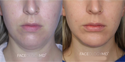 Case 9003 - Woman treated with Chin Liposuction, Chin Implant