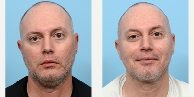 Case 9004 - 45-54 year old man treated with Chin Liposuction