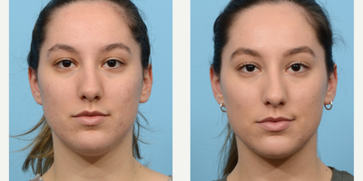 Case 9005 - 18-24 year old woman treated with Chin Liposuction