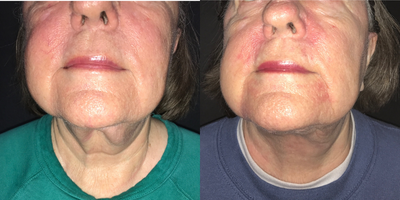 Case 9006 - Woman treated with Chin Liposuction