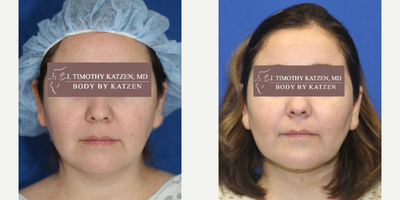 Case 9007 - 35-44 year old woman treated with Chin Liposuction