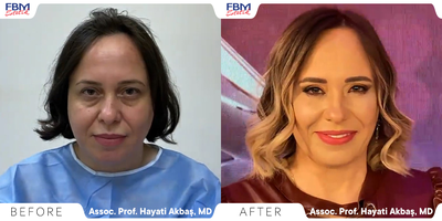 Case 9008 - 35-44 year old woman treated with Mini Facelift, Buccal Fat Removal, Facial Fat Transfer, Chin Liposuction