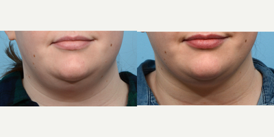 Case 9009 - 25-34 year old woman treated with Chin Liposuction