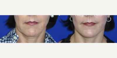 Case 9011 - Woman treated with Chin Liposuction, Facelift, Neck Lift, CO2 Laser