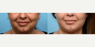 Case 9012 - 25-34 year old woman treated with Chin Implant, Chin Liposuction