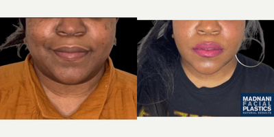 Case 9013 - 35-44 year old woman treated with Buccal Fat Removal, Chin Liposuction