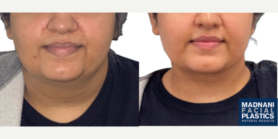 Case 9014 - 25-34 year old woman treated with Chin Liposuction, Buccal Fat Removal