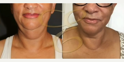 Case 9016 - Woman treated with Chin Liposuction