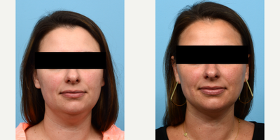 Case 9017 - 35-44 year old woman treated with Chin Liposuction