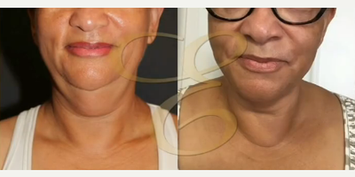 Case 9018 - Woman treated with Chin Liposuction