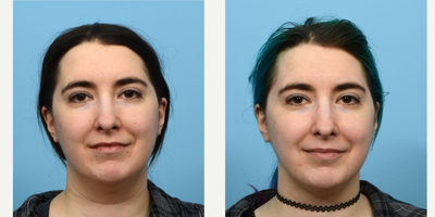 Case 9019 - 25-34 year old woman treated with Chin Liposuction