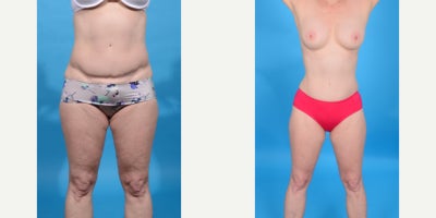 Case 902 - 45-54 year old woman treated with Abdominal Etching, Diastasis Recti Repair, Drainless Tummy Tuck, Liposculpture, Liposuction, M