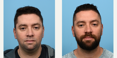 Case 9020 - 35-44 year old man treated with Chin Implant, Chin Liposuction