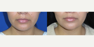 Case 9021 - Woman treated with Chin Liposuction
