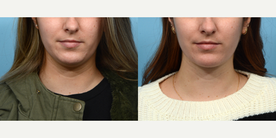 Case 9024 - 25-34 year old woman treated with Chin Liposuction