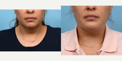 Case 9025 - 35-44 year old woman treated with Chin Liposuction