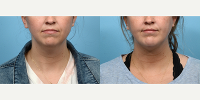 Case 9026 - 25-34 year old woman treated with Chin Liposuction