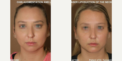 Case 9028 - Woman treated with Chin Liposuction