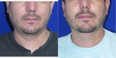 Case 9030 - 36 year old man treated with Chin Liposuction