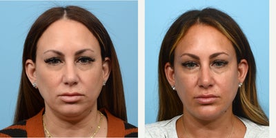 Case 9031 - 35-44 year old woman treated with Chin Liposuction