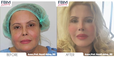 Case 9033 - 35-44 year old woman treated with Chin Liposuction, Neck Lift, Mini Facelift
