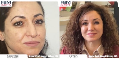 Case 9034 - 45-54 year old woman treated with Rhinoplasty, Chin Liposuction