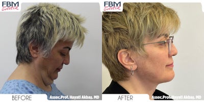 Case 9036 - 45-54 year old woman treated with Neck Lift, Chin Liposuction