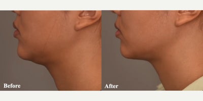 Case 9043 - Woman treated with Chin Liposuction