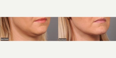 Case 9044 - Woman treated with Chin Liposuction