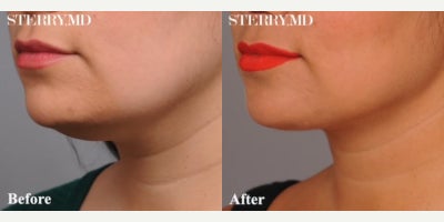 Case 9045 - Woman treated with Chin Liposuction