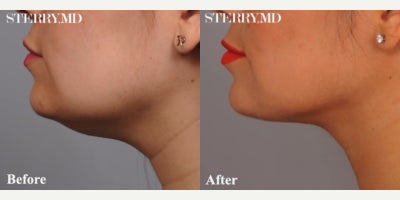 Case 9046 - Woman treated with Chin Liposuction
