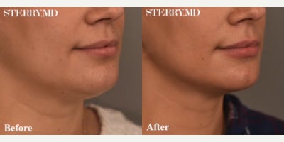 Case 9047 - Woman treated with Chin Liposuction
