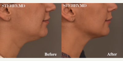 Case 9048 - Woman treated with Chin Liposuction