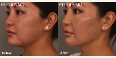Case 9049 - Woman treated with Chin Liposuction