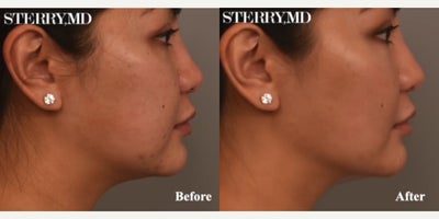 Case 9050 - Woman treated with Chin Liposuction