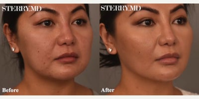 Case 9051 - Woman treated with Chin Liposuction