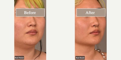 Case 9052 - Woman treated with Chin Liposuction