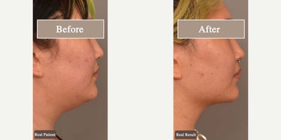 Case 9053 - Woman treated with Chin Liposuction