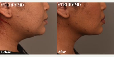 Case 9054 - Woman treated with Chin Liposuction