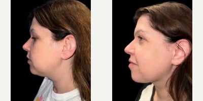 Case 9055 - Woman treated with Chin Liposuction