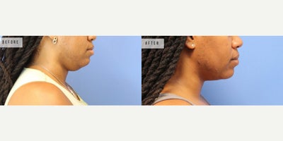 Case 9056 - Woman treated with Chin Liposuction