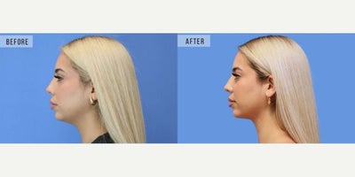 Case 9058 - Woman treated with Chin Liposuction